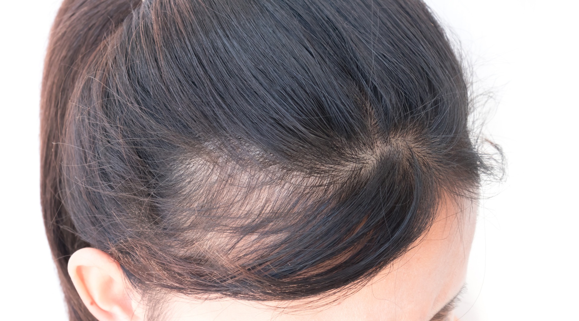 androgenetic alopecia
