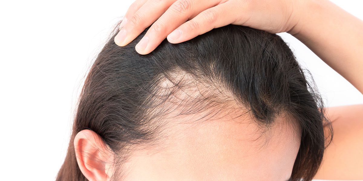 Androgenetic Alopecia Belirtileri