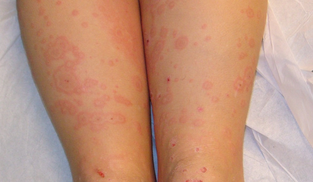 Erythema Multiforme