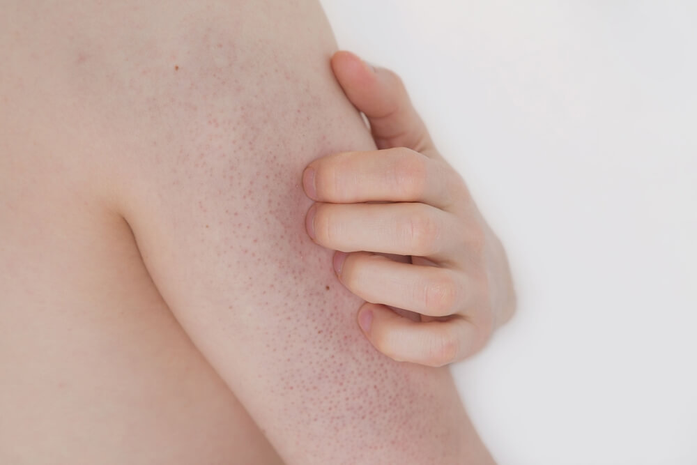 Keratosis Pilaris Belirtileri