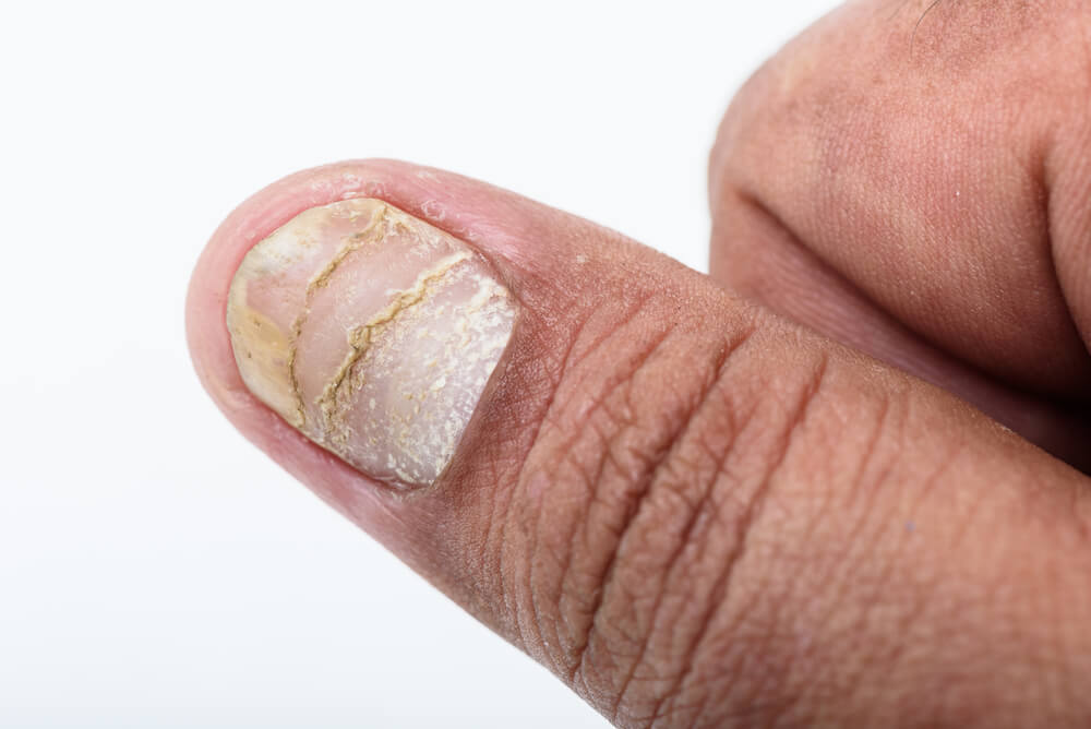 psoriasis tırnak belirtisi