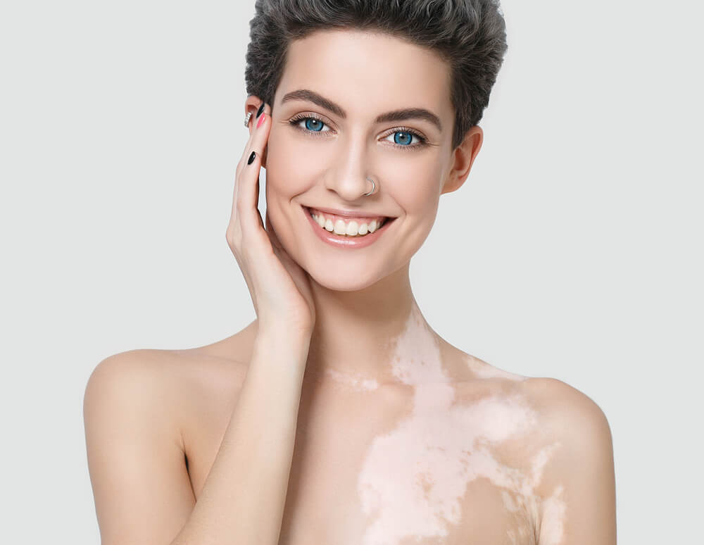 vitiligo tedavi